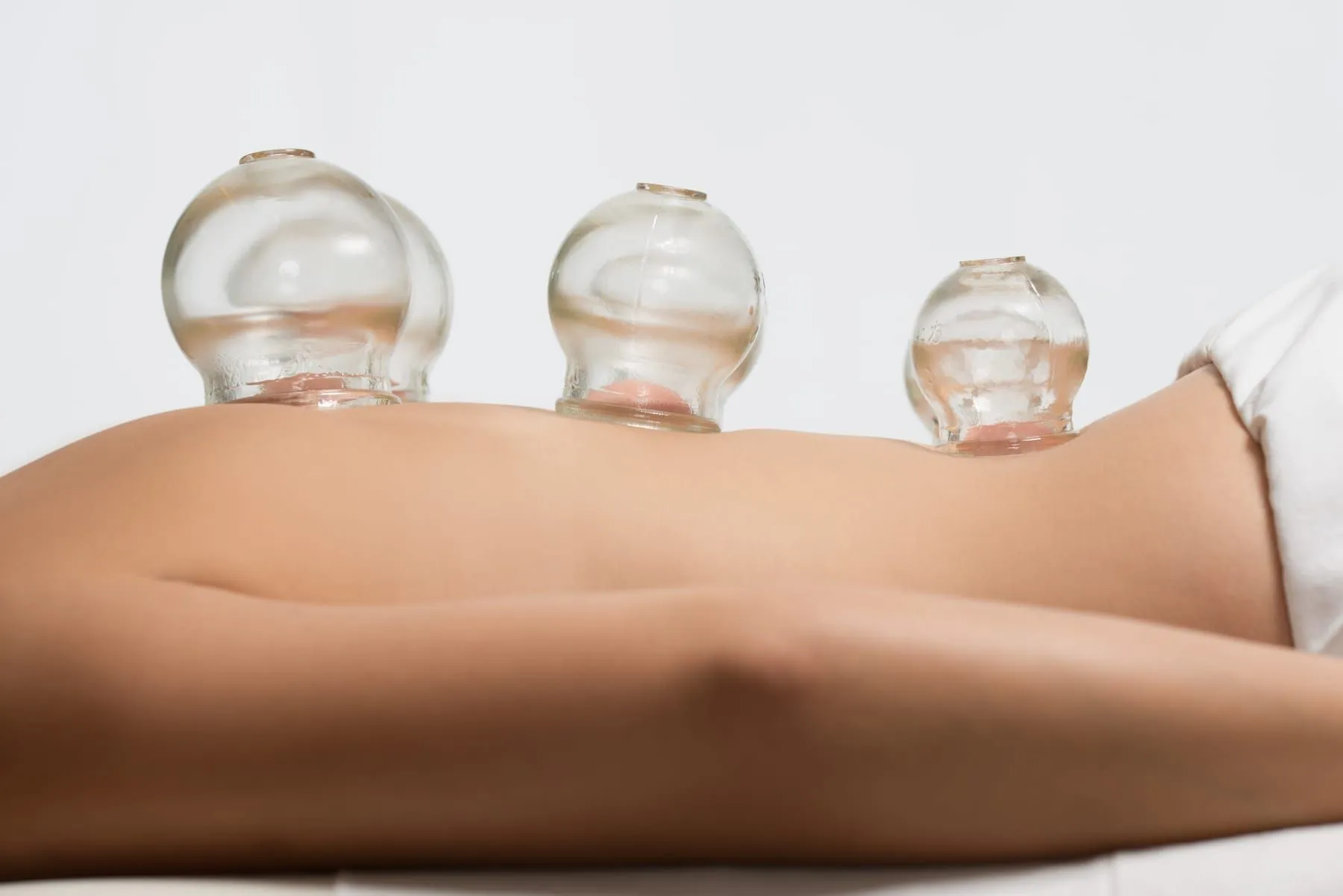 Cupping Therapy